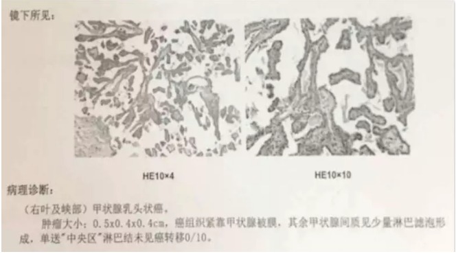 別慌，甲狀腺疾病還可以這樣投保！